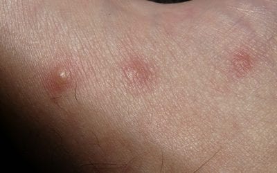 Hives vs. Angioedema